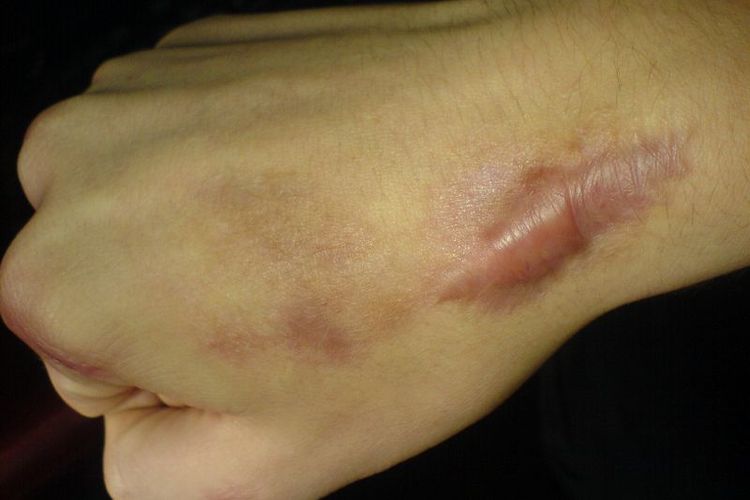 Pengobatan Keloid: Langkah-Langkah Menuju Kulit yang Sehat