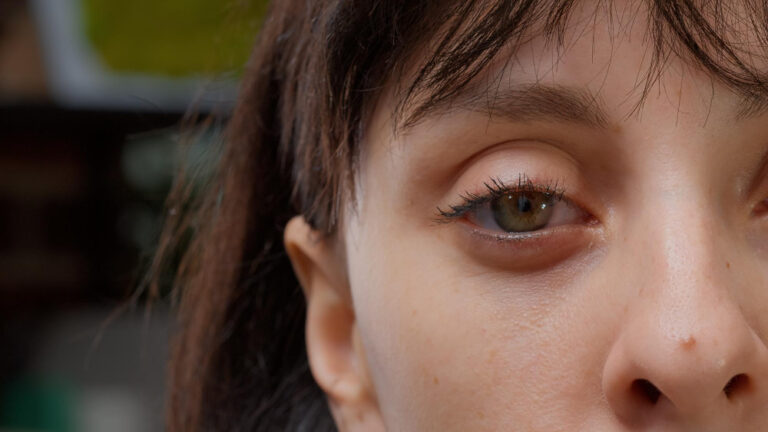 lazy eyes